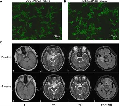 Case report: Rapid symptom relief in autoimmune encephalitis with efgartigimod: a three-patient case series